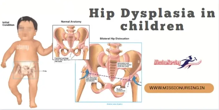 Hip Dysplasia in children