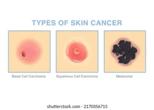 Major Types of skin cancer