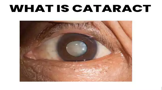What is Cataract SignsSymptoms, Causes, Treatment & Management