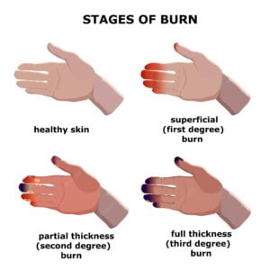 Burn classification / Types of Burn