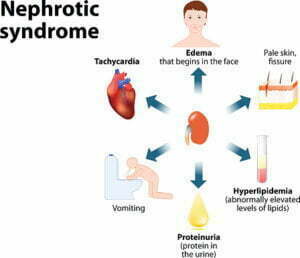 Nephrotic Syndrome Treatments, Causes, & Symptoms