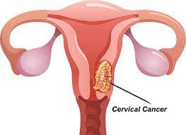 What is Cervical cancer Cause, Types, and Treatment