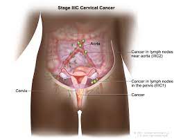 What is Cervical cancer Cause, Types, and Treatment