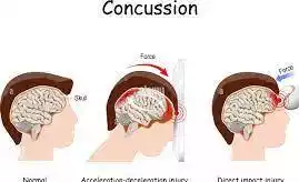 Head Injury Pictures Concussion
