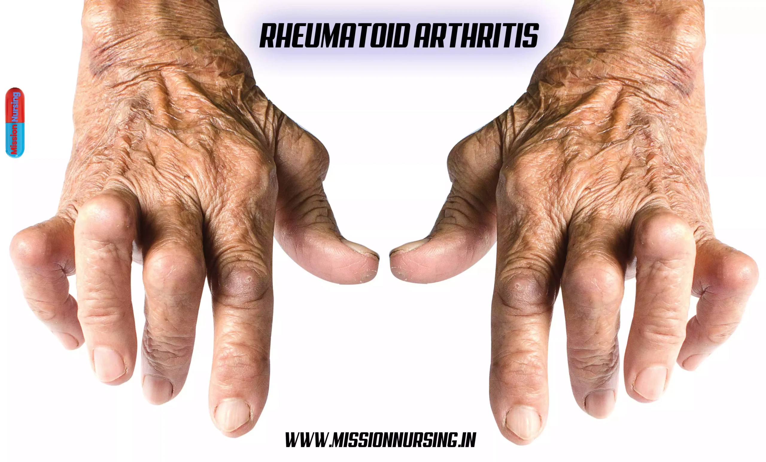 Rheumatoid arthritis Causes, symptoms, treatment